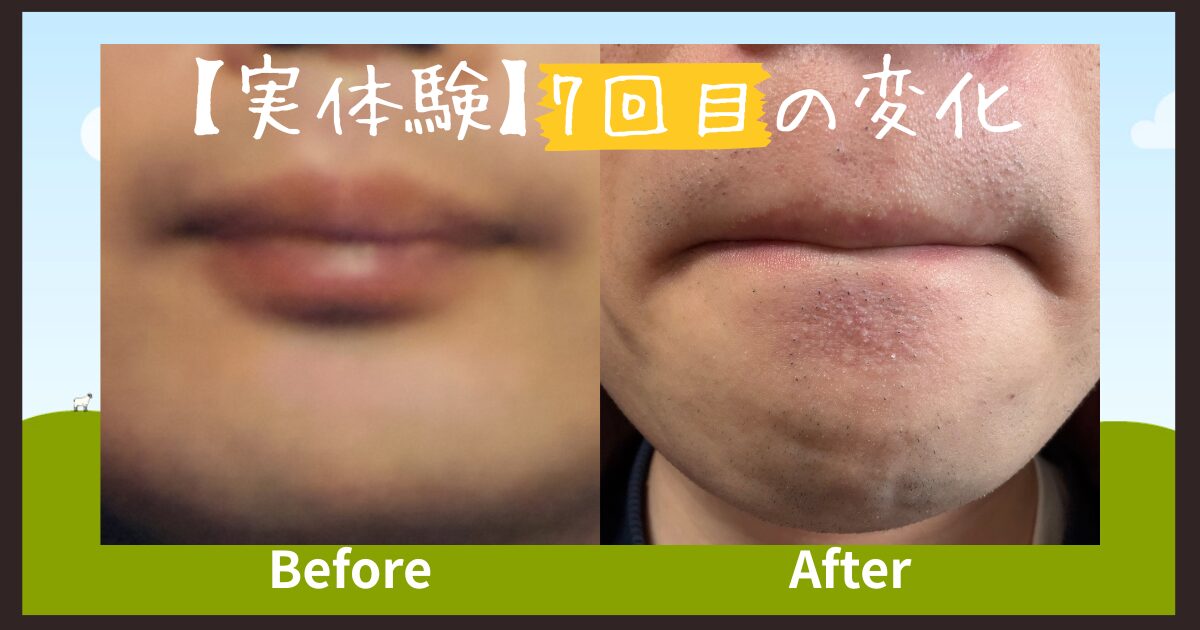 【実体験】ヒゲ脱毛7回目の変化