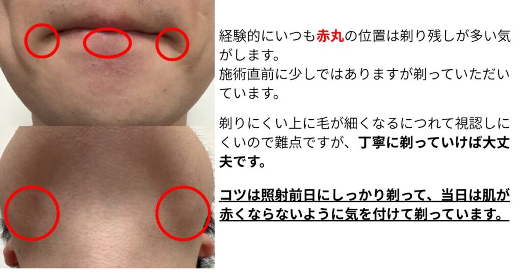 施術前の剃毛テクニック