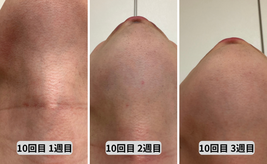 照射10回目1～3週目アゴ下