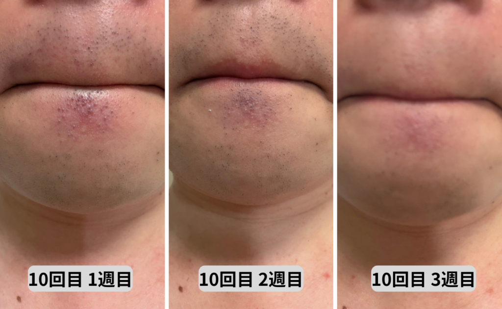 照射10回目1～3週目口回り