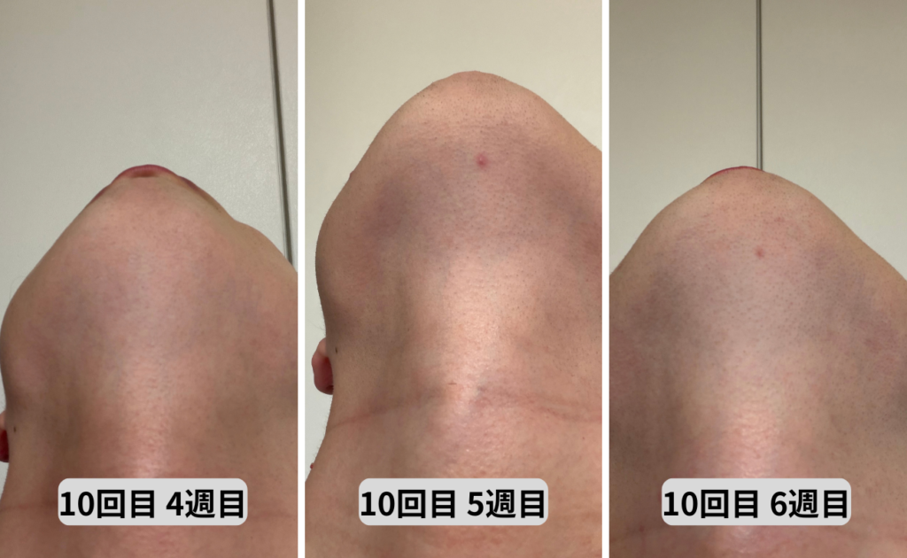 照射10回目4～6週目アゴ下