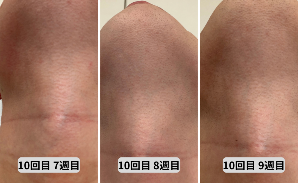 照射10回目7～9回目アゴ下