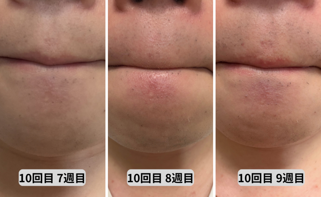 照射10回目7～9週目口回り