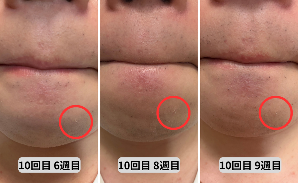 10回目 白髪