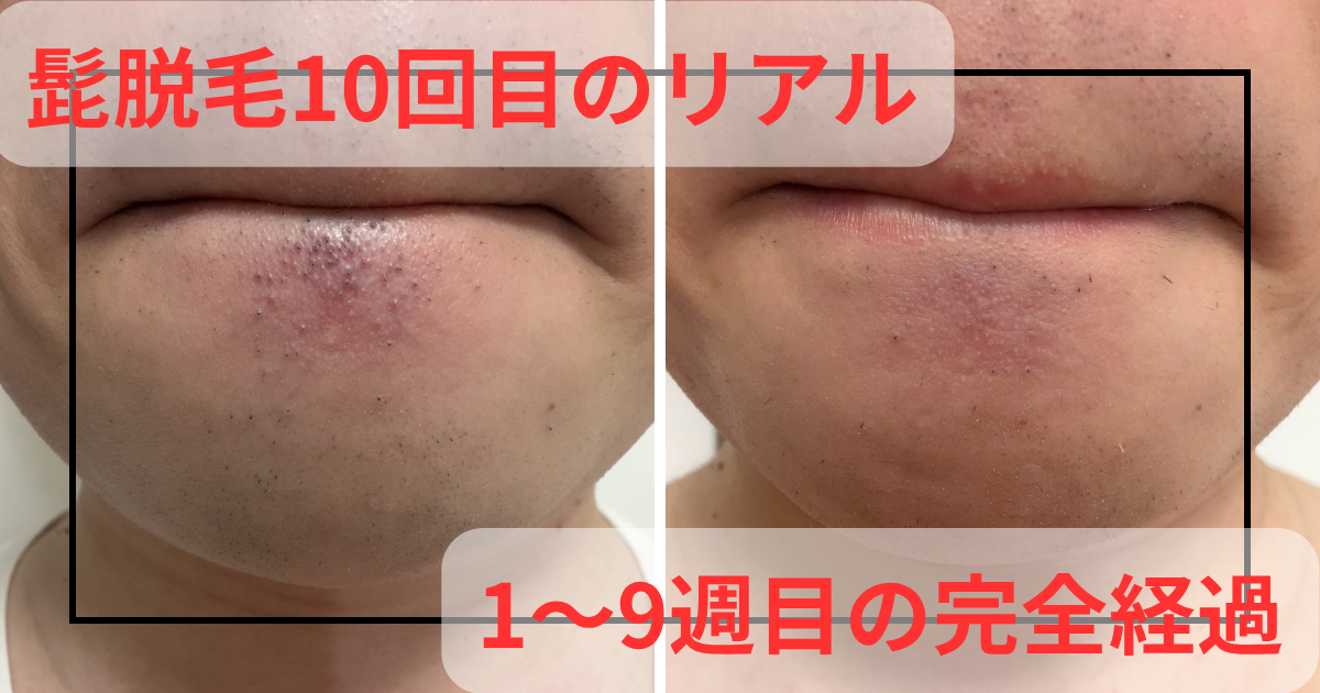 照射10回目 アイキャッチ